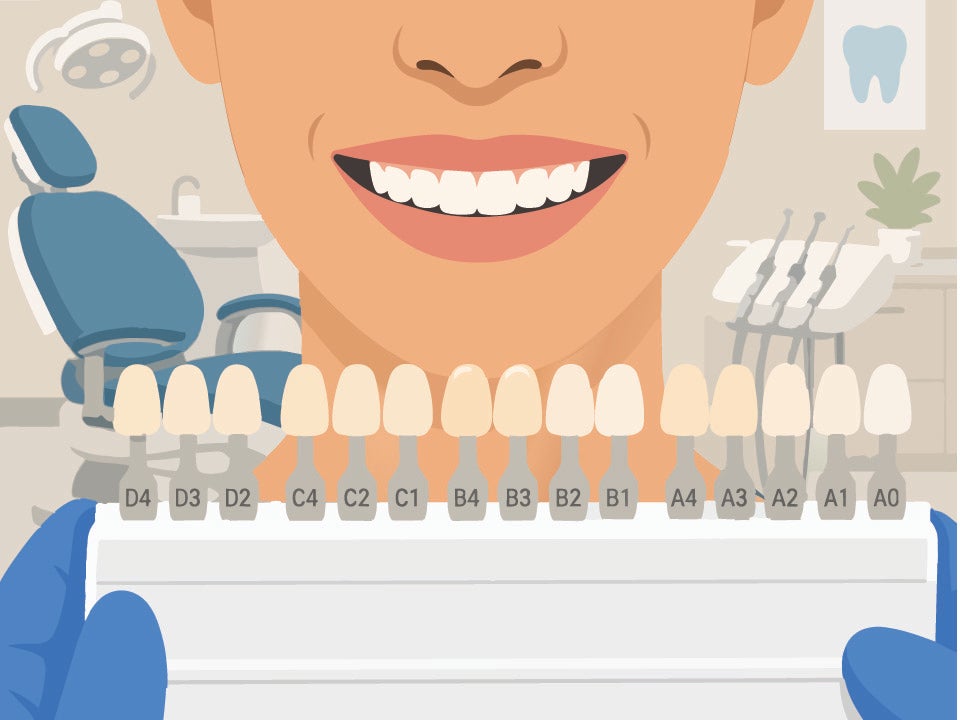 Veeners in a row being held up towards patient's teeth