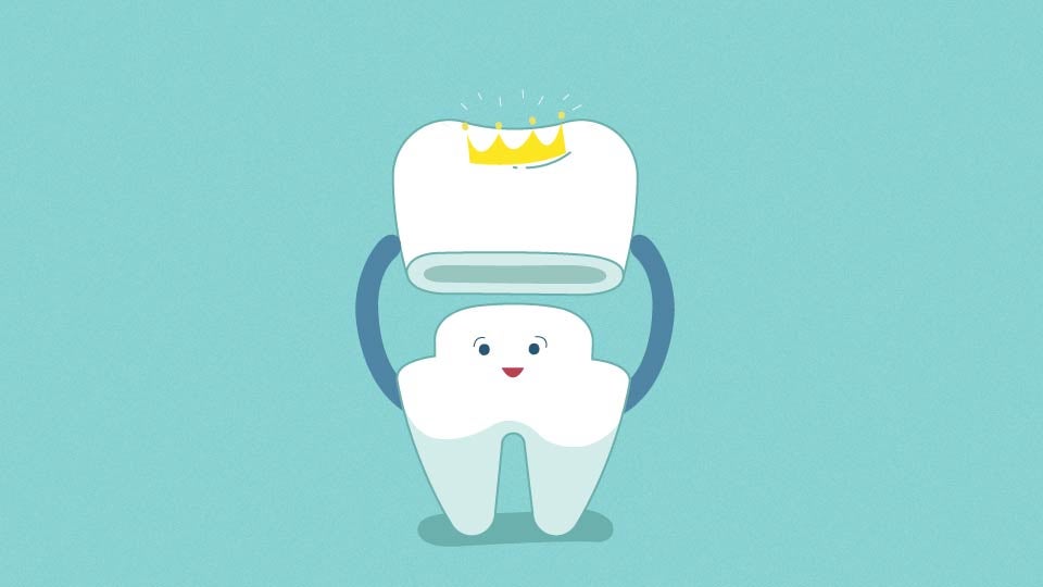 Permanent crown smiling