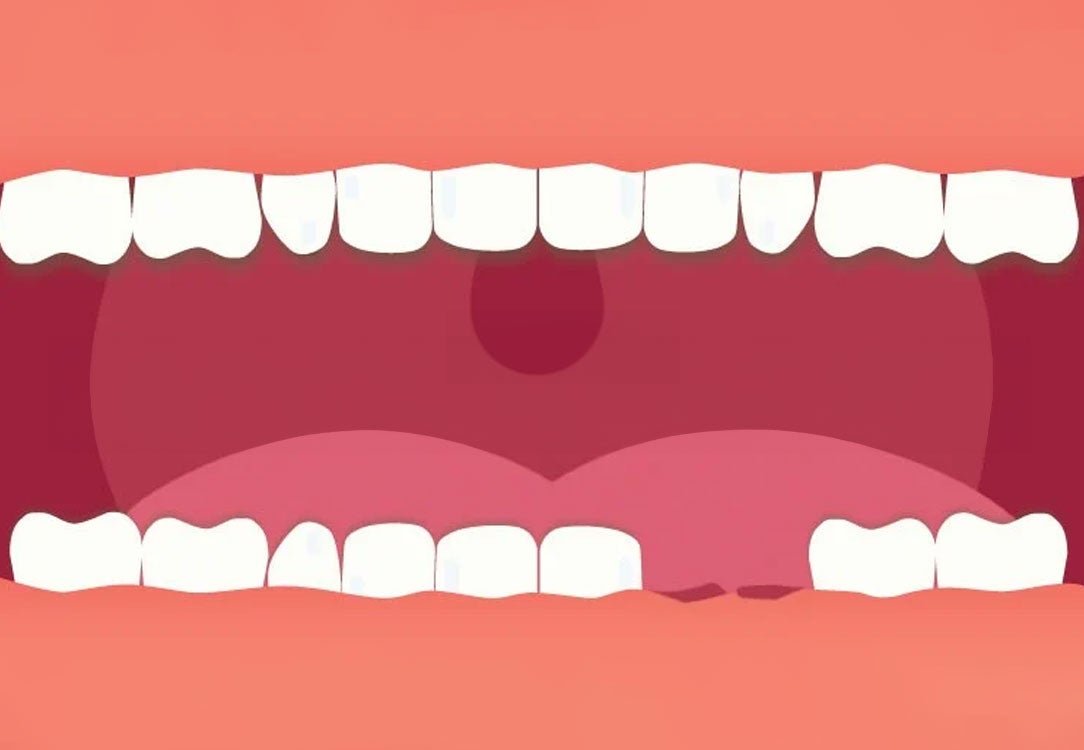 Full image of an open mouth with two missing lower teeth and empty sockets