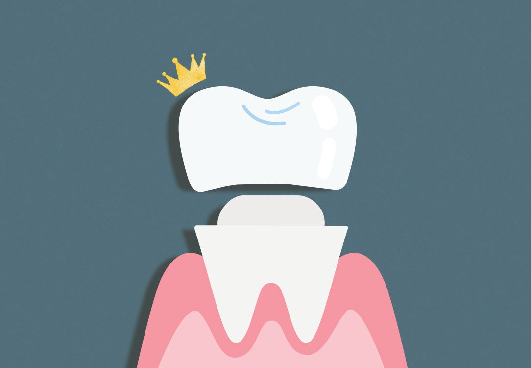 Tooth on gums with a dental crown and royal crown on it