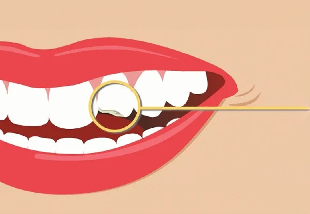 3/4 mouth with a circle over chipped tooth