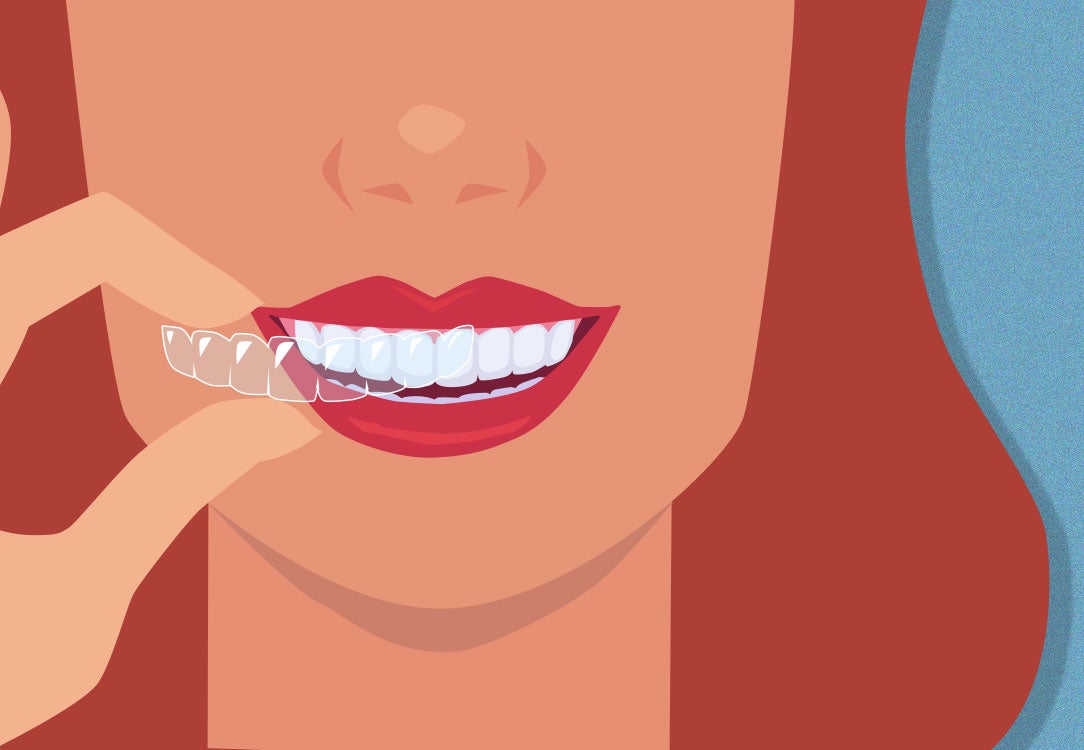 Woman putting on clear aligners