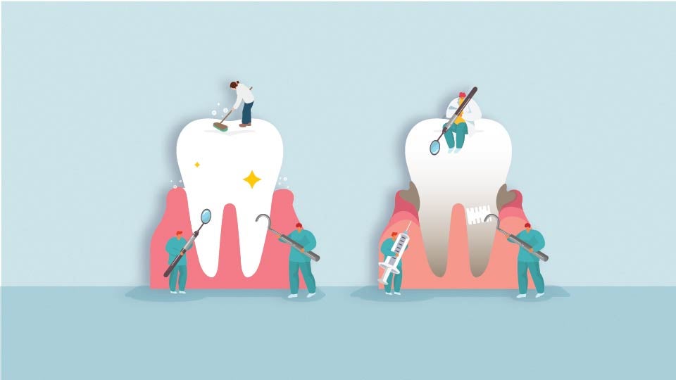Image of a Deep Cleaning and another tooth getting a regular cleaning