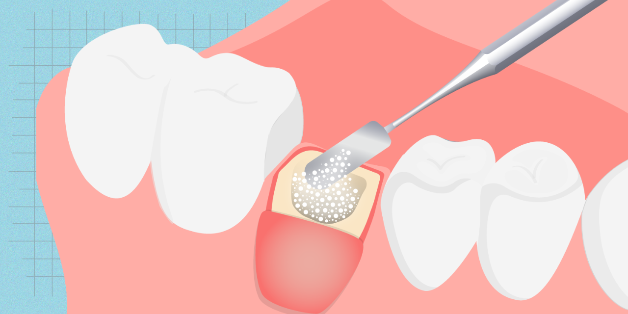 Dental Bone Graft