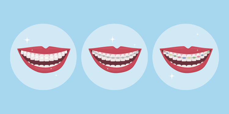 Types of Braces